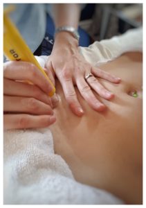 Cupping is a fantastic tool to help reduce cesarean scar adhesions